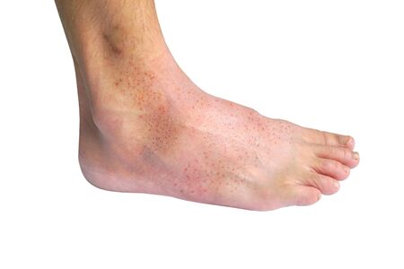 Red rash on foot isolated on white background / Rashes with virusの写真素材