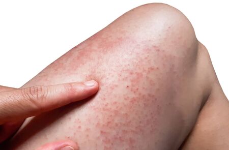 Red rash on leg isolated on white bacjground / Rashes with virusの写真素材