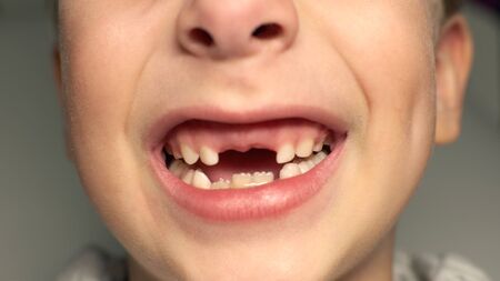 6 years kid showing missing teeth, he has lost two calfs teeth. Close up portrait of blonde caucasian boy smiling demonstrating white teeth without two front teeth.の写真素材