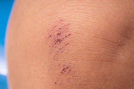 close up of little scab wound on kid's knee  due to learning to walk and fallの写真素材