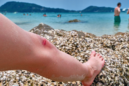 Bleeding on the knee of a boy. Child wounded his leg against a coral reef on tropical beach. Concept...