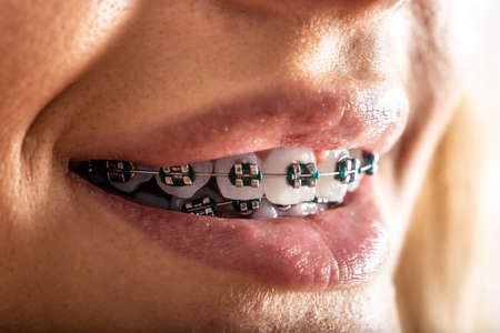 Extreme detail of teeth with a dental braces in the mouth of a young woman.の写真素材