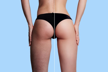 Concept skincare.The skin on the thighs of a young woman before and after cosmetic procedures.Cellulite treatment program for women, weight loss. over background with copy space.の写真素材