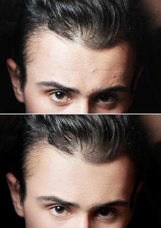 Young man portrait, isolated on a black background. Before and after cosmetic or plastic procedure,...