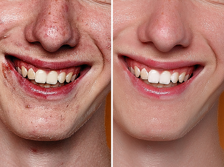 Before and after cosmetic operation. Young man portrait, studio background. Before and after...