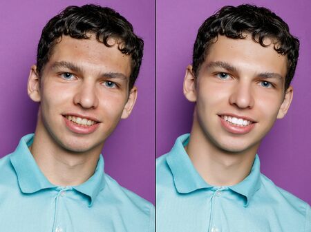 Before and after cosmetic operation. Young man portrait. Before and after cosmetic or plastic procedure, anti-age therapy, removal of acne, retouching. studio shotの写真素材