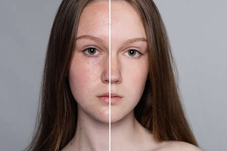 health, people, youth and beauty concept - Before and after cosmetic operation. Young pretty woman portrait. Before and after cosmetic or plastic procedure anti-age therapy, treatmentの写真素材