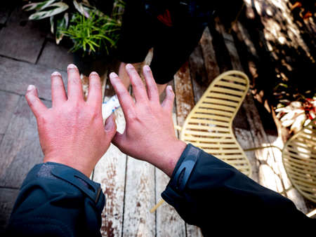 Both Hands have Swelling and Redness , Which is Caused by Cold Weather Allergiesの写真素材