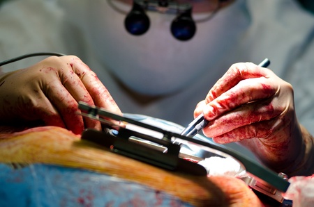 a real cardiac surgery, a closeup shotのeditorial素材