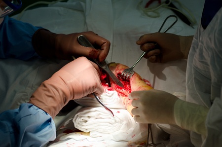 a real surgical operation on forearm bonesの写真素材