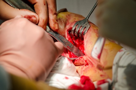 a real surgical operation on forearm bonesのeditorial素材