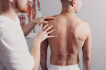 sportsman back after marking of vacuum cupping, sport therapyの写真素材