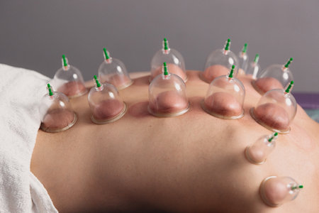 Cup massage close up. Banks for massage on the mans back. Massage with vacuum cups.の写真素材