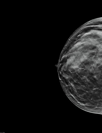 Mammogram. Right bilateral craniocaudal (CC) view (with tomosynthesis and C-view reconstruction), fibroglandular and lipomatous structure (ACR C), benign calcifications, cystsの写真素材