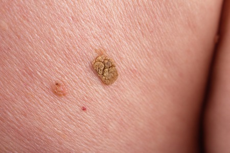 the doctor examines the birthmarks on the man's body.の写真素材