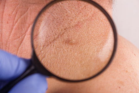 the doctor examines the birthmarks on the man's body.の写真素材