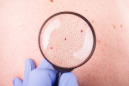 the doctor examines the birthmarks on the man's body.の写真素材
