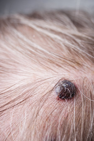 melanoma, late-stage skin cancer, on an old man's head.