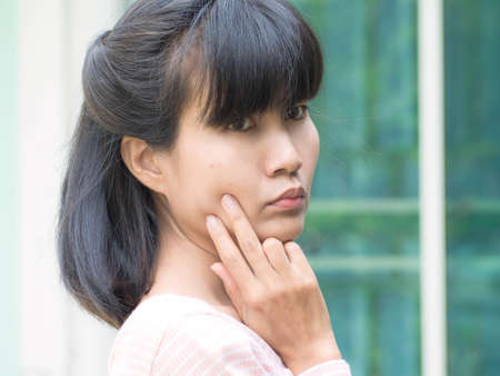 Acne woman. Authentic black hair, black eyes and skin tan asian Thailand. portrait beauty girl show face with little acne. for presentation foam face or lotion cream moisturizer skin care cosmetics.の写真素材