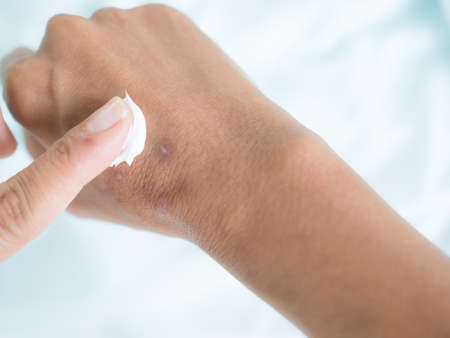 Scar on hand woman. finger applying removal blister wound on skin body with blue background. drug medicine cosmetic cream lotion moisturizer for beauty and good health. showing dark scar skin tan.の写真素材