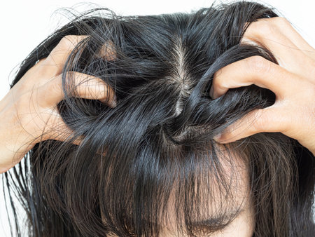 Dandruff Hair Scalp Sebum Woman Close up, Fungus Skin Itch Head Problem Trouble Dirty Dry Scratch Seborrhea, Asian Brown Hair.の写真素材