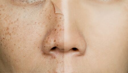 Before and After Retouching Freckles on Asian Woman Face, Skin Problemsの写真素材