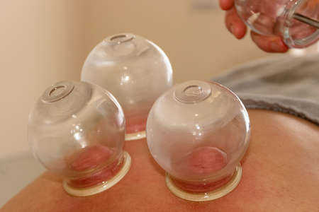 A closeup shot of three glass vases placed on skin during a massage sessionの写真素材