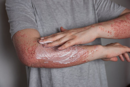 Woman applying moisturizer to skin with psoriasis with her hand on her forearmの写真素材