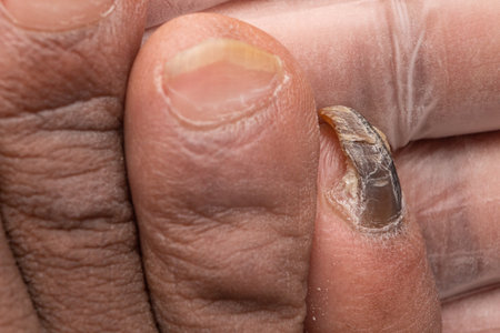 Blackened little toenail destructed by fungal infection. Fungus disease deforming toenail. Medicine and health care concept.の写真素材