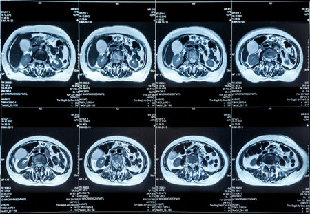 MRI scan of the Human Abdomen organsのeditorial素材