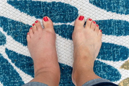 A closeup shot of feet with a pedicure with one foot swollen from a wasp bite