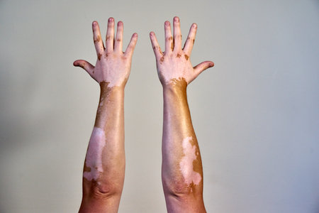 A vitiligo skin disease on male handsの写真素材