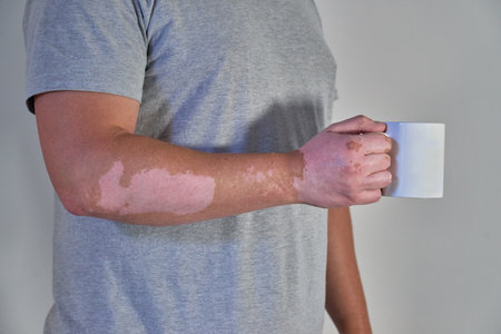 A man's hand with vitiligo discoloration disease holding a cup of coffeeの写真素材