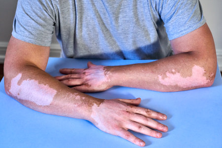 A vitiligo skin disease on male handsの写真素材