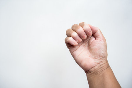 A view of Vitiligo disease on a hand isolated on a white backgroundの写真素材