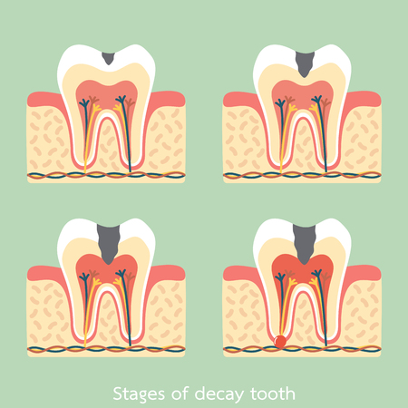 dental cartoon vector flat style for design, stages of decay tooth anatomy structure including the bone and gumのイラスト素材