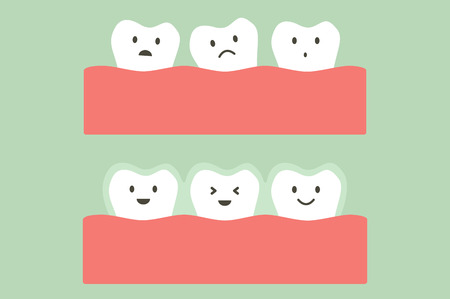 tooth cartoon vector flat style for design - before and after teeth wear silicone trainer or invisible braces, dental health conceptのイラスト素材