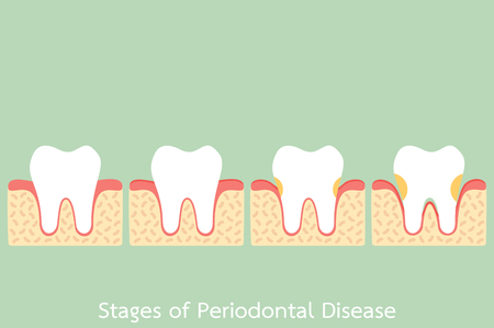 tooth cartoon vector flat style for design - step of periodontal disease / periodontitis / gingivitis / gum disease, dental problemのイラスト素材