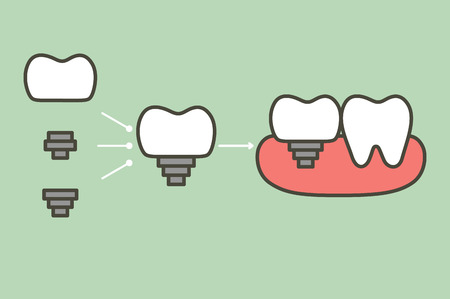 structure of the dental implant with all partsのイラスト素材