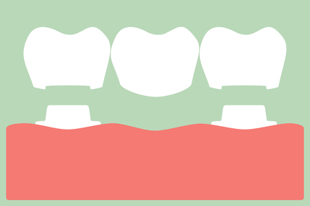 dental crown with bridge, installation process and change of teeth - tooth cartoon vector flat style cute character for designのイラスト素材