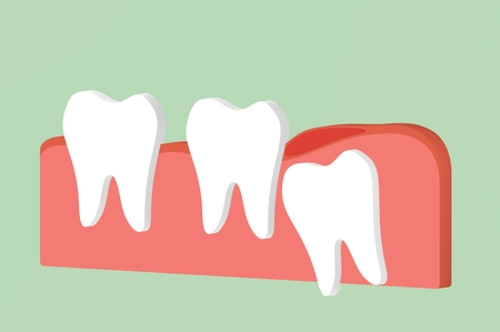 wisdom tooth ( angular or mesial impaction ) with inflammation affect to other teeth - dental cartoon 3d render flat style cute character for designの写真素材