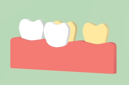 tooth whitening by veneers teeth - dental cartoon 3d render flat style cute character for designの写真素材