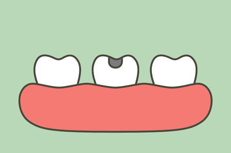 decay tooth or dental caries - teeth cartoon vector flat style cute character for designのイラスト素材