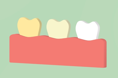 yellow to white tooth, teeth whitening concept - dental cartoon 3d render flat style cute character for designの写真素材