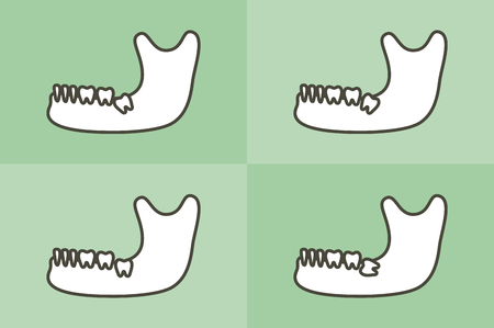 set of type of wisdom tooth in mandible or lower jaw - dental cartoon vector flat style cute character for designのイラスト素材