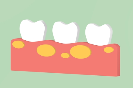 unhealthy teeth because gingivitis with abscess in gum - dental cartoon 3d render flat style cute character for designの写真素材