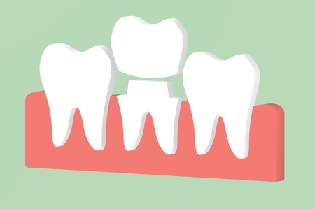 dental crown, installation process and change of teeth - tooth cartoon 3d render flat style cute character for designの写真素材