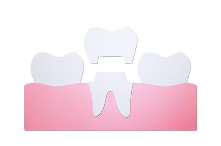 dental crown, installation process and change of teeth - tooth cartoon paper cut style cute character for designの写真素材