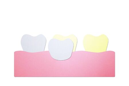 dental veneers, putting new veneers on discolored tooth - teeth cartoon paper cut style cute character for designの写真素材