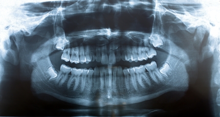 panoramic x-ray image of teethの写真素材